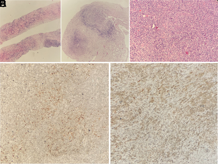 Should Core Needle Lymph Node Biopsy be a Relevant Alternative to Surgical Excisional Biopsy in Diagnostic Work Up of Lymphomas?