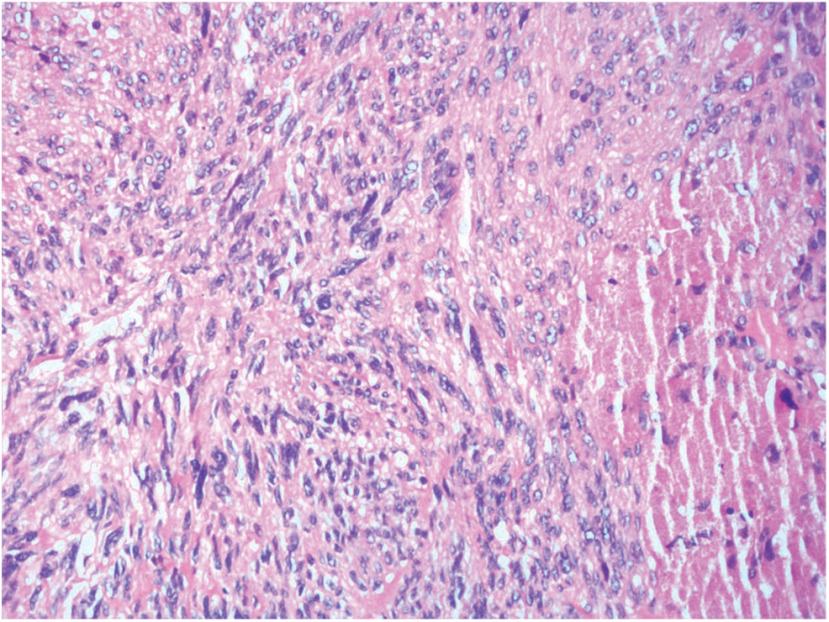 Reconstruction of the Esophagus with Sternohyoid Flap after Resection of a Large Cervical Esophageal Leiomyosarcoma.