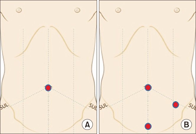 A prospective randomized controlled study comparing patient-reported scar evaluation of single-port versus multiport laparoscopic appendectomy for acute appendicitis.