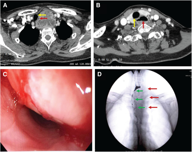 Reconstruction of the Esophagus with Sternohyoid Flap after Resection of a Large Cervical Esophageal Leiomyosarcoma.