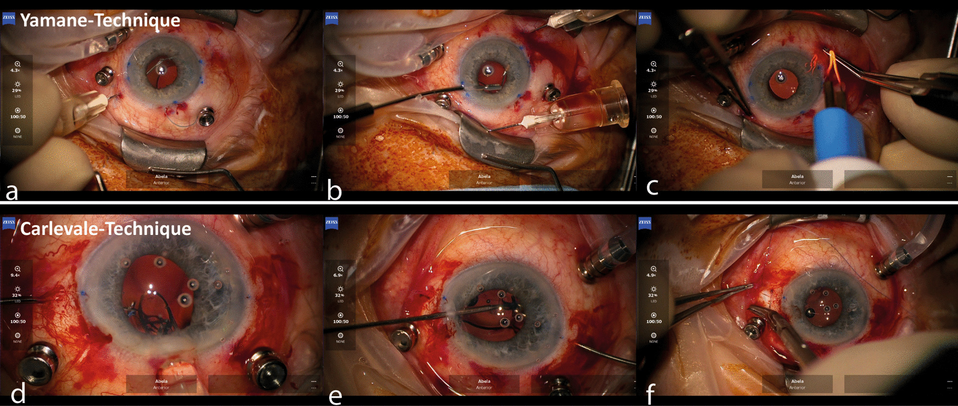 Refractive outcome and lens power calculation after intrascleral intraocular lens fixation: a comparison of three-piece and one-piece intrascleral fixation technique.