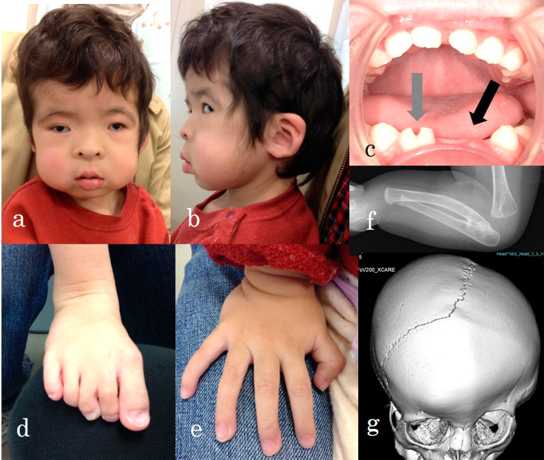 Oculofaciocardiodental syndrome caused by a novel BCOR variant.