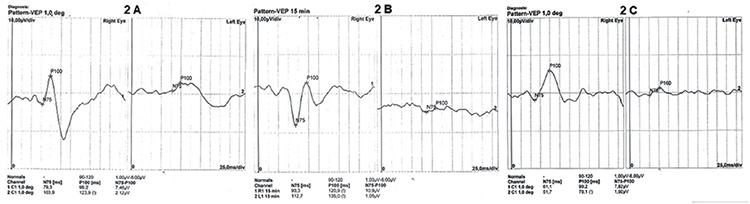 Late-Onset Neuromyelitis Optica Spectrum Disorder Mimicking a Non-Arteritic Anterior Ischemic Optic Neuropathy-Case Report.