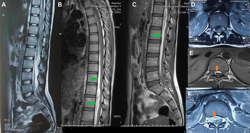 Spinal Subdural Hematoma following Epidural Anesthesia.