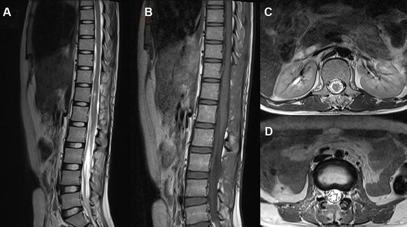 Spinal Subdural Hematoma following Epidural Anesthesia.