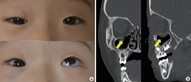 Exercise rehabilitation for recurrent extraocular muscle movement limitation after pediatric blowout fracture surgery: a case report.