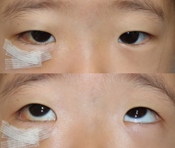 Exercise rehabilitation for recurrent extraocular muscle movement limitation after pediatric blowout fracture surgery: a case report.