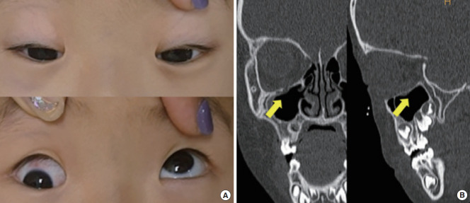 Exercise rehabilitation for recurrent extraocular muscle movement limitation after pediatric blowout fracture surgery: a case report.