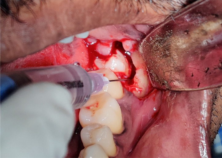 Efficacy of intraosseous saline injection for pain management during surgical removal of impacted mandibular third molars: a randomized double-blinded clinical trial.