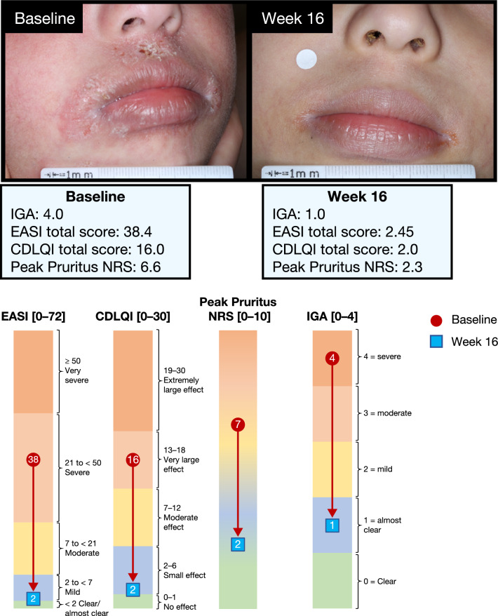 Dupilumab Provides Clinically Meaningful Responses in Children Aged 6–11 Years with Severe Atopic Dermatitis: Post Hoc Analysis Results from a Phase III Trial