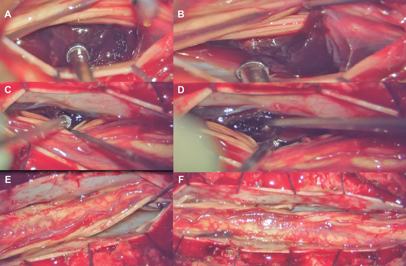 Spinal Subdural Hematoma following Epidural Anesthesia.