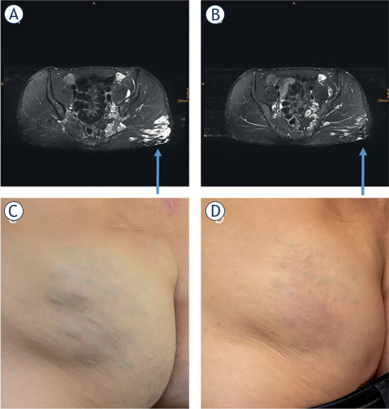 Bleomycin electrosclerotherapy (BEST) for the treatment of vascular malformations. An International Network for Sharing Practices on Electrochemotherapy (InspECT) study group report.