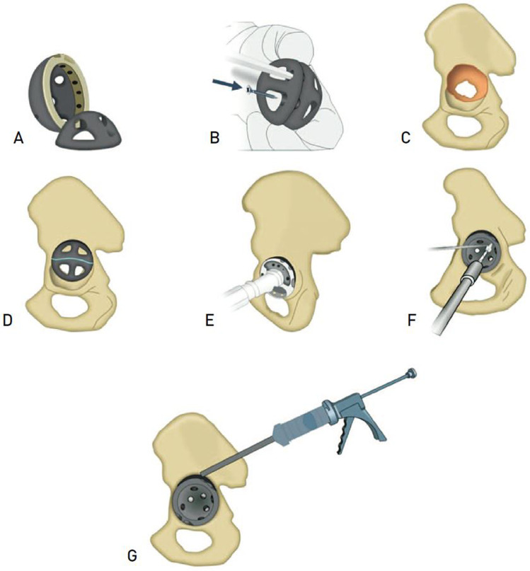 The Dome Technique for Managing Massive Anterosuperior Medial Acetabular Bone Loss in Revision Total Hip Arthroplasty: Short-Term Outcomes.