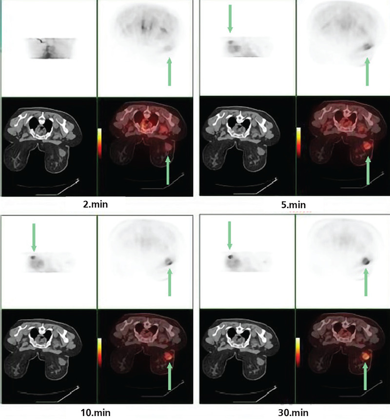 Value of Dynamic <sup>18</sup>F-FDG PET/CT in Predicting the Success of Neoadjuvant Chemotherapy in Patients with Locally Advanced Breast Cancer: A Prospective Study.