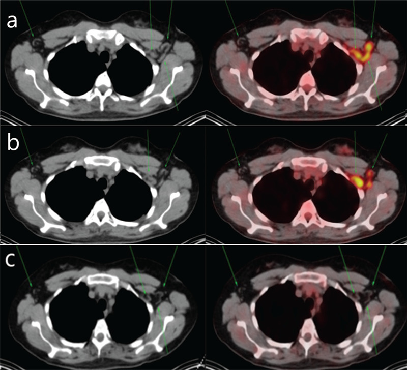 Hypermetabolic Axillary Lymph Nodes Associated with COVID-19 Vaccination in Breast Cancer Management.