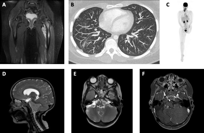 Beyond germline genetic testing - heterozygous pathogenic variants in PMS2 in two children with Osteosarcoma and Ependymoma.