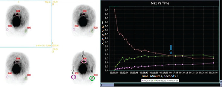 Value of Dynamic <sup>18</sup>F-FDG PET/CT in Predicting the Success of Neoadjuvant Chemotherapy in Patients with Locally Advanced Breast Cancer: A Prospective Study.