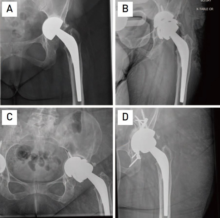 The Dome Technique for Managing Massive Anterosuperior Medial Acetabular Bone Loss in Revision Total Hip Arthroplasty: Short-Term Outcomes.