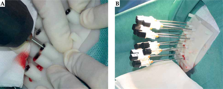 Three-dimensional template combined with MR-guided iodine-125 brachytherapy for recurrent brain metastases.