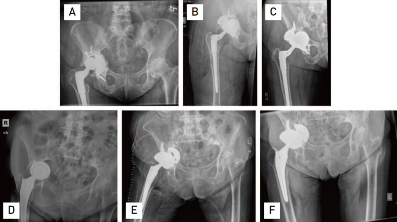 The Dome Technique for Managing Massive Anterosuperior Medial Acetabular Bone Loss in Revision Total Hip Arthroplasty: Short-Term Outcomes.