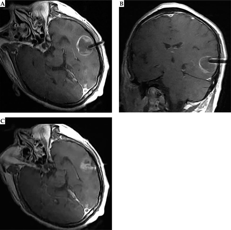 Three-dimensional template combined with MR-guided iodine-125 brachytherapy for recurrent brain metastases.