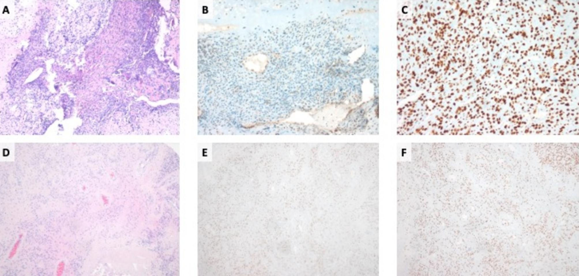 Beyond germline genetic testing - heterozygous pathogenic variants in PMS2 in two children with Osteosarcoma and Ependymoma.