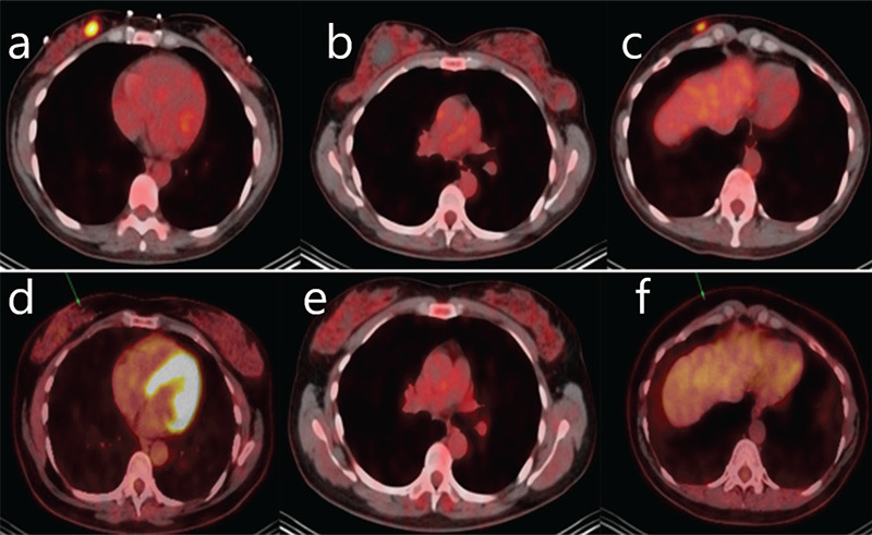 Hypermetabolic Axillary Lymph Nodes Associated with COVID-19 Vaccination in Breast Cancer Management.