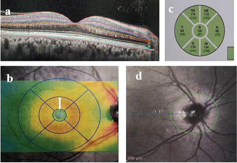 Regional Analysis of Inner Retinal Layer Changes in Multiple Sclerosis with and without Optic Neuritis.