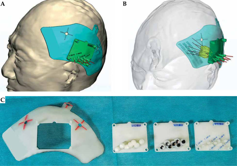 Three-dimensional template combined with MR-guided iodine-125 brachytherapy for recurrent brain metastases.