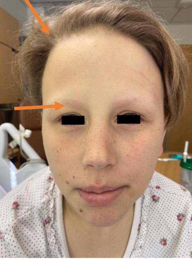 A Rare Case of Severe Jaundice in a Panhypopituitarism Patient.