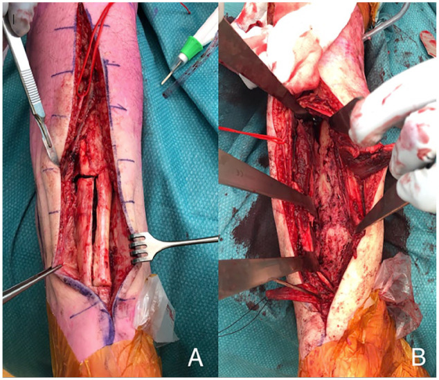 Blade Plate With Autogenous Bone Grafting to Salvage Peri Ankle Nonunions.