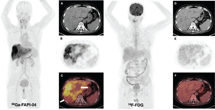 <sup>68</sup>Ga-FAPI-04 PET/CT Findings in Patients with Liver Cirrhosis.