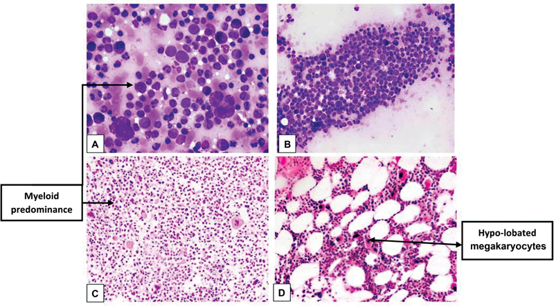 Pure Red Cell Aplasia Encountered in a Tertiary Care Hematology Laboratory: A Series of Nine Distinctive Cases.