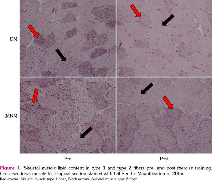 Exercise training attenuates skeletal muscle fat infiltration and improves insulin pathway of patients with immune-mediated necrotizing myopathies and dermatomyositis.