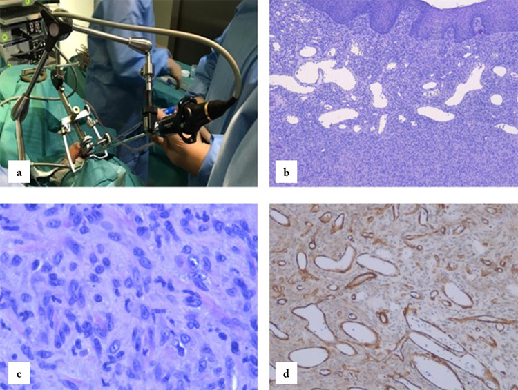 Recurrent Pediatric Extranasopharyngeal Angiofibroma of the Epiglottis: Case Report.