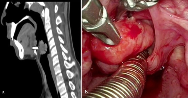 Recurrent Pediatric Extranasopharyngeal Angiofibroma of the Epiglottis: Case Report.