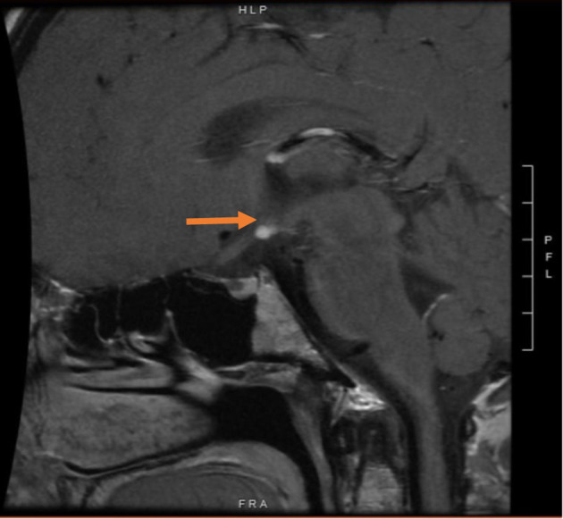 A Rare Case of Severe Jaundice in a Panhypopituitarism Patient.