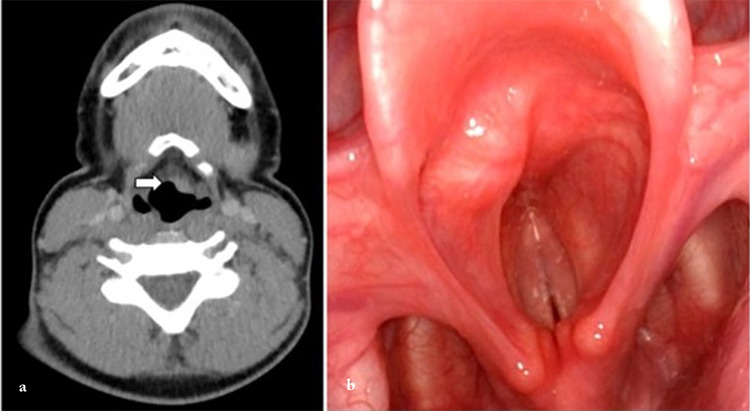 Recurrent Pediatric Extranasopharyngeal Angiofibroma of the Epiglottis: Case Report.