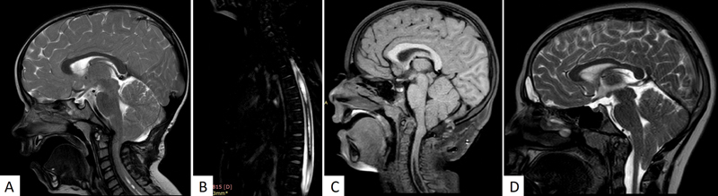 Hundred Pediatric Cases Treated for Chiari Type II Malformation with Hydrocephalus and Myelomeningocele.