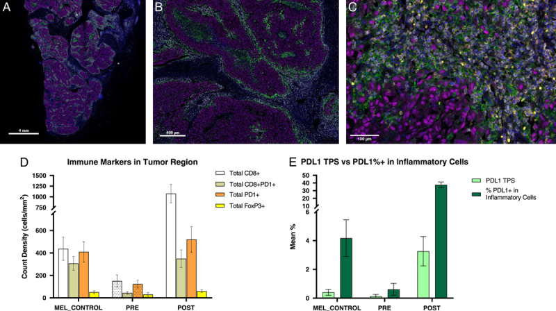 Brief Communication on Pathologic Assessment of Persistent Stable Metastatic Lesions in Patients Treated With Anti-CTLA-4 or Anti-CTLA-4 + Anti-PD-1 Therapy.