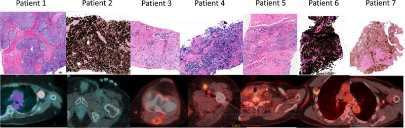 Brief Communication on Pathologic Assessment of Persistent Stable Metastatic Lesions in Patients Treated With Anti-CTLA-4 or Anti-CTLA-4 + Anti-PD-1 Therapy.