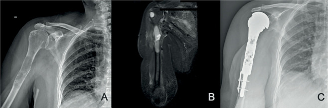 Bone turnover profile and muscular status in major orthopaedic surgery: a case series.