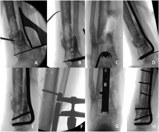 Blade Plate With Autogenous Bone Grafting to Salvage Peri Ankle Nonunions.