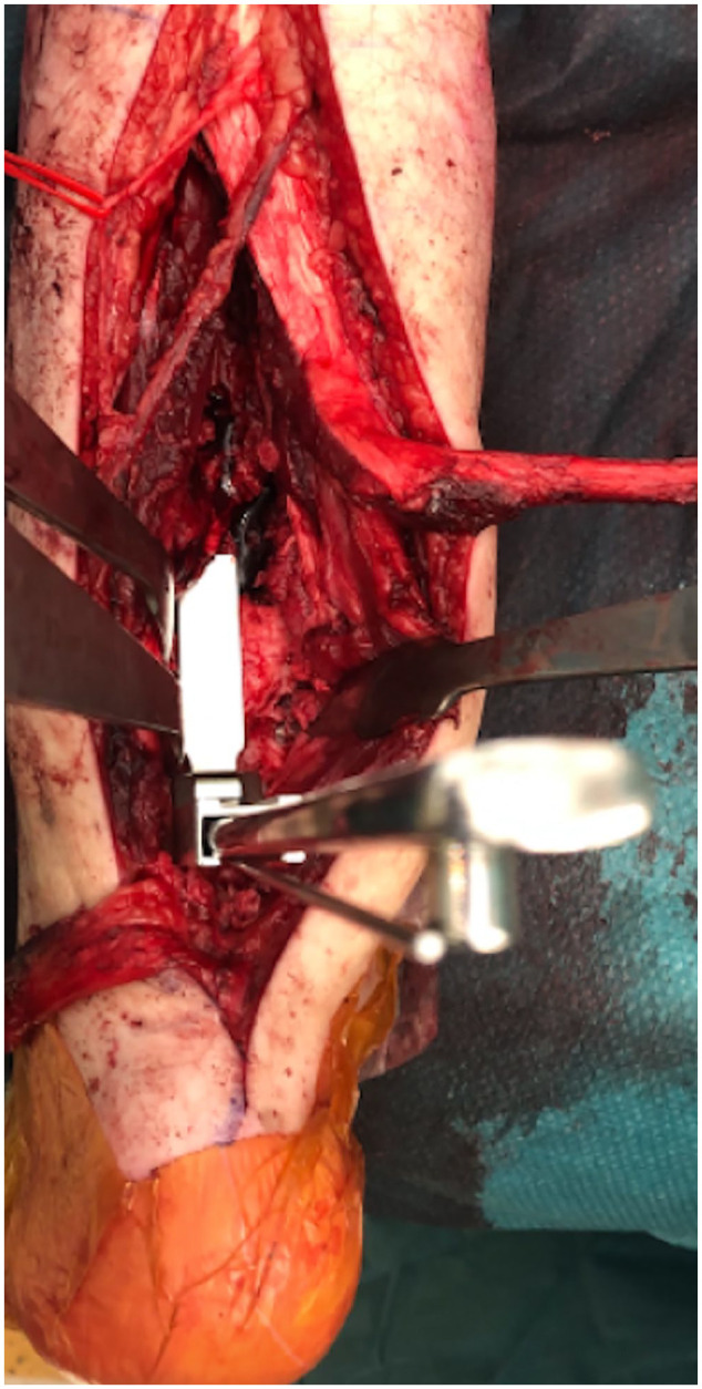 Blade Plate With Autogenous Bone Grafting to Salvage Peri Ankle Nonunions.