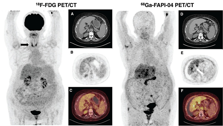 <sup>68</sup>Ga-FAPI-04 PET/CT Findings in Patients with Liver Cirrhosis.