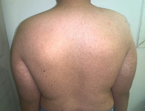 Generalized keratosis pilaris induced by testosterone injections in a patient with CHARGE syndrome.