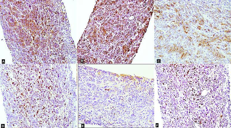 Amelanotic Melanoma: A Great Masquerader.