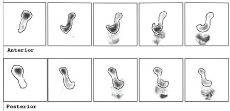 Gastric Emptying Scintigraphy: Diagnostic Value of Delayed Imaging and the Impact on Reclassification of Diagnosis.