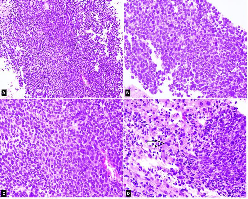 Amelanotic Melanoma: A Great Masquerader.