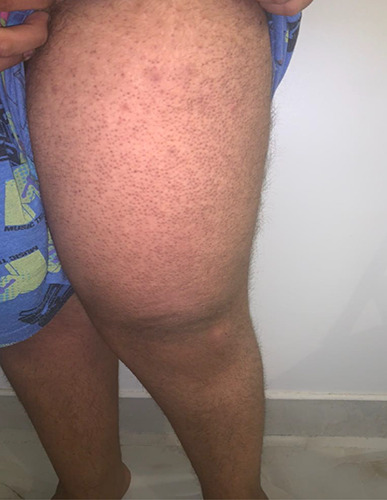 Generalized keratosis pilaris induced by testosterone injections in a patient with CHARGE syndrome.